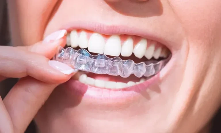 braces-clear-aligner-dental-clinic-kuala-lumpur-malaysia-dentist