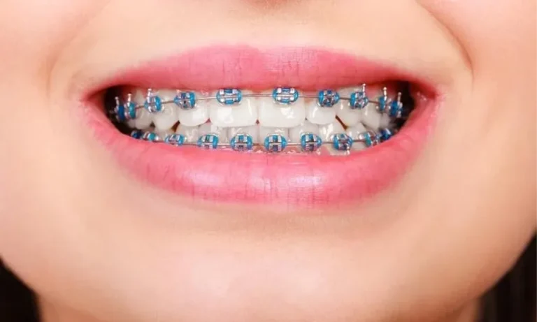 braces-conventional-dental-clinic-kuala-lumpur-malaysia-dentist