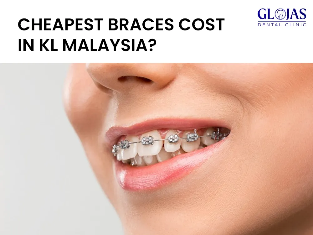 braces-cost-in-kl-malaysia