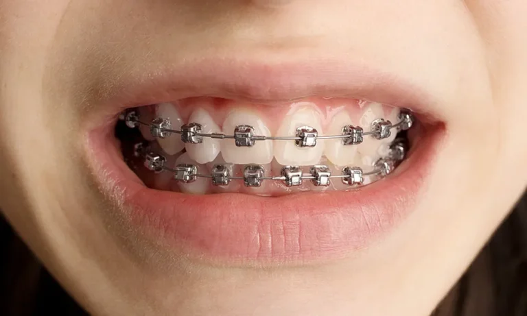 braces-dental-clinic-kuala-lumpur-malaysia-dentist-3