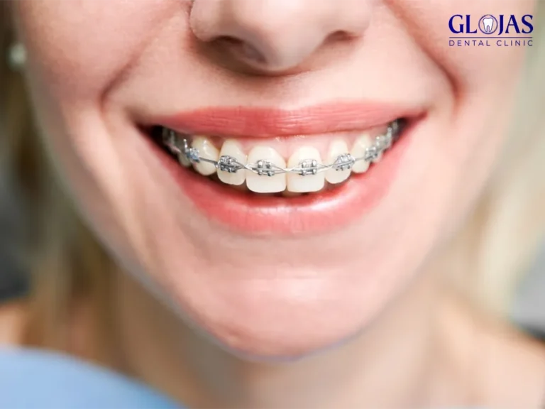 braces-dentistry-dental-clinic-malaysia-klinik-pergigian-kuala-lumpur-1