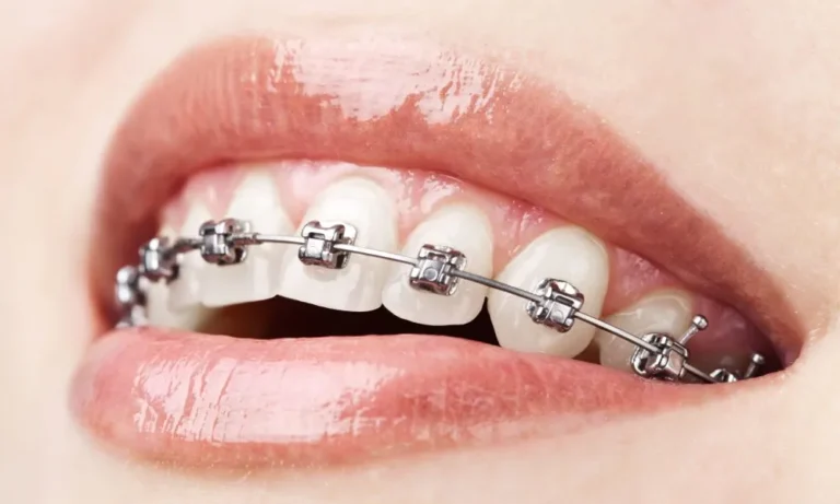 braces self ligating dental clinic kuala lumpur malaysia dentist