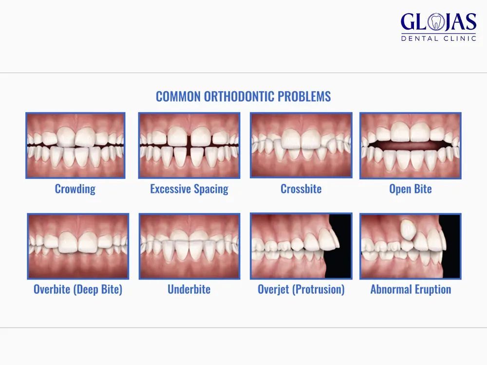 braces-teeth-condition-dental-clinic-malaysia-klinik-pergigian-kuala-lumpur