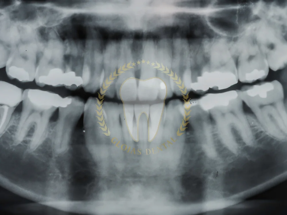 canine-impacted-tooth-surgery