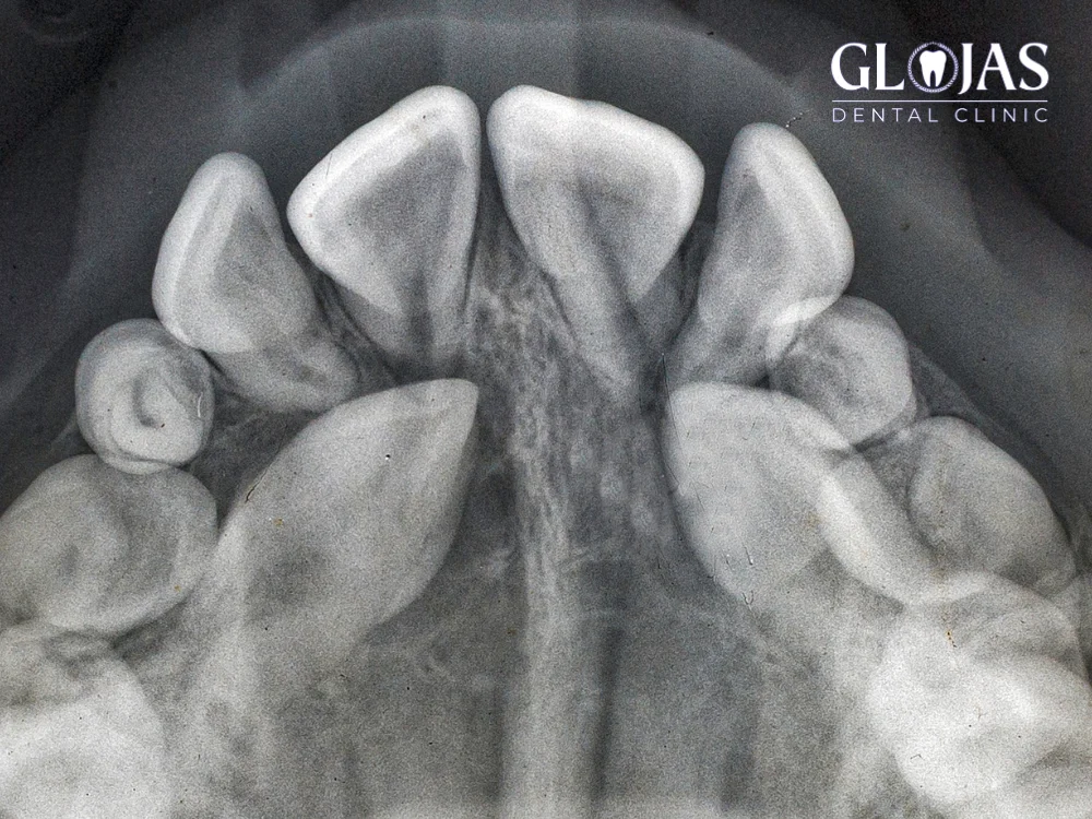 Truth About Canine Impacted Tooth Surgery: 7 Crucial Things You Need to Know 23 canine-impacted-tooth-surgery
