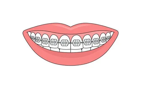 ceramic braces dental clinic malaysia klinik pergigian kuala lumpur