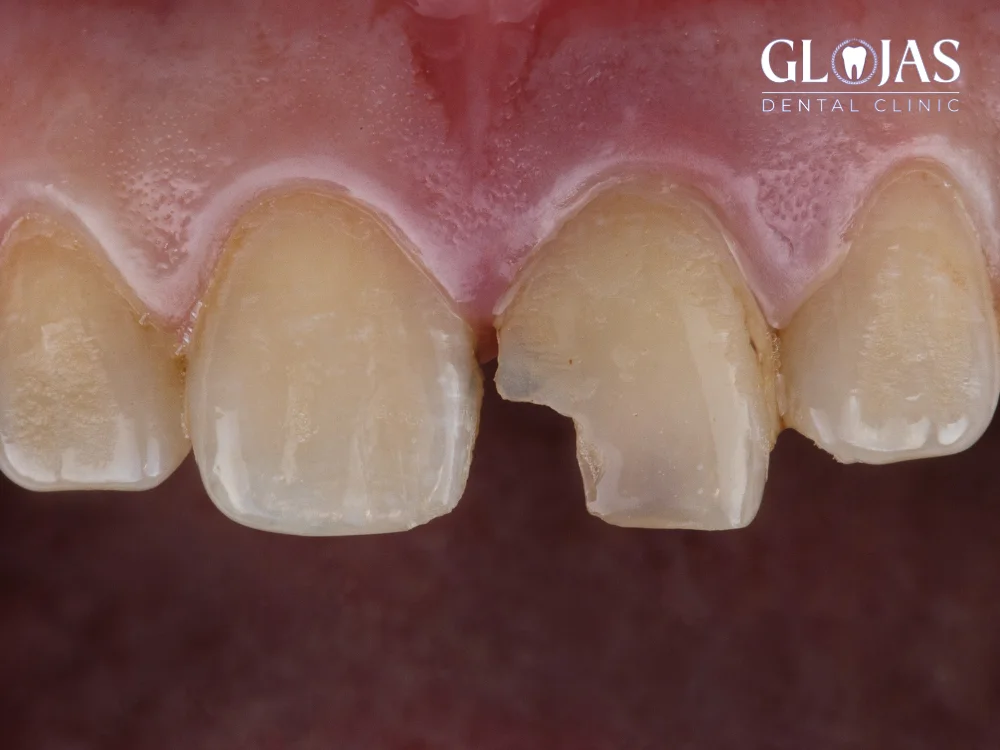 5 Proven Ways to Fix a Chipped Tooth Quickly and Safely 17 chipped-tooth