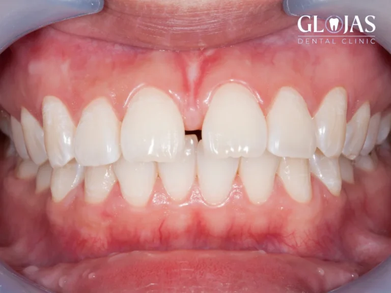 close-diastema