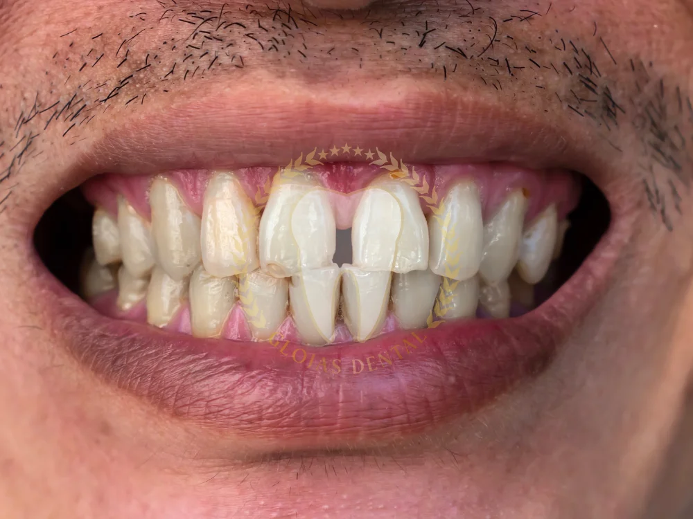 close-diastema