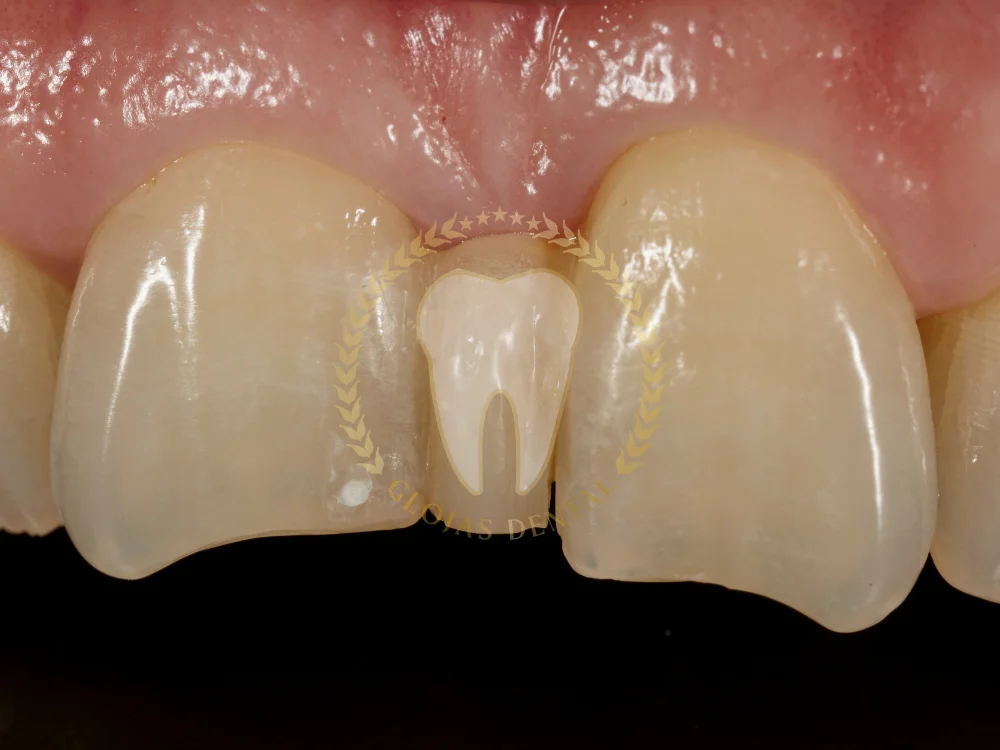 close-diastema