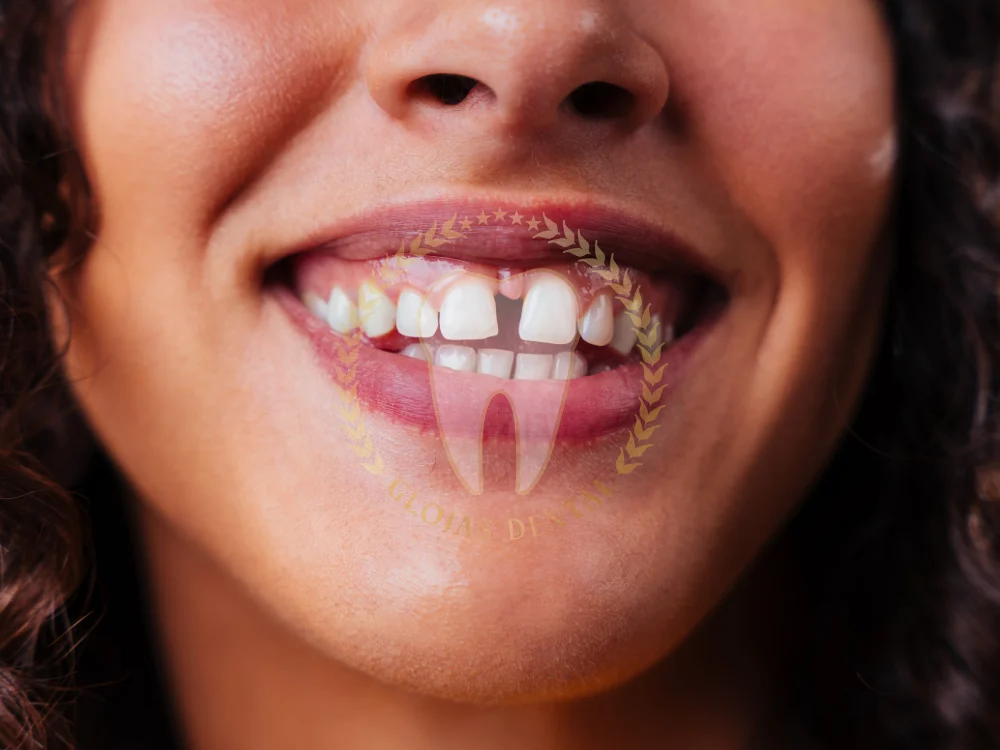 close-diastema