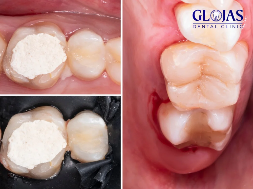5 Incredible Benefits of Composite Teeth You Can’t Ignore 5 composite-teeth