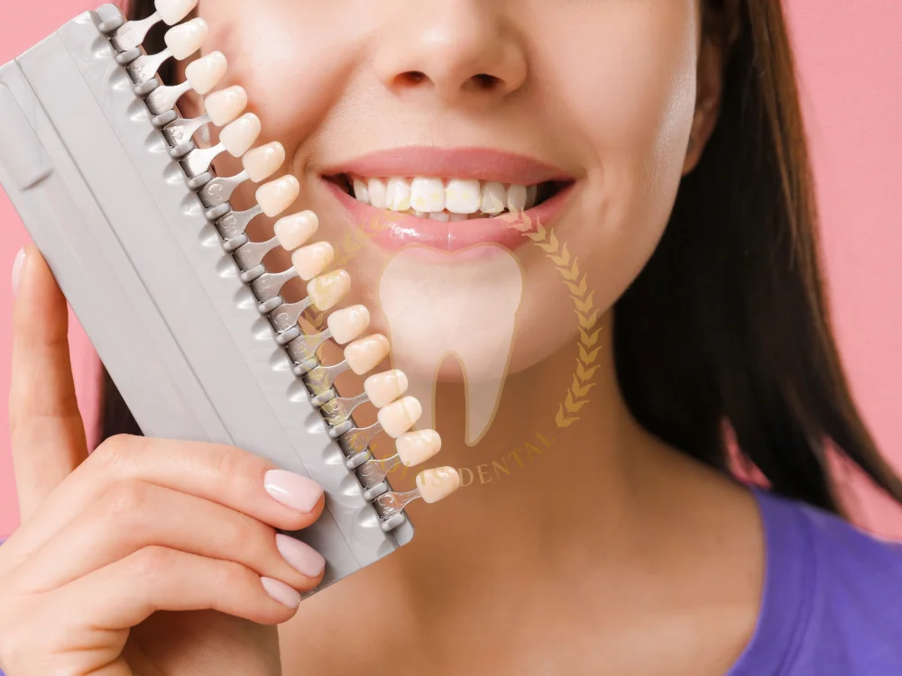 composite-veneers