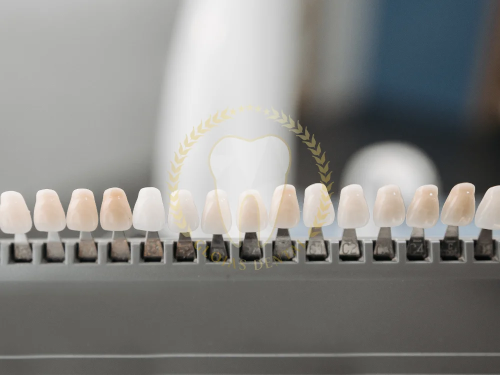 composite-veneers