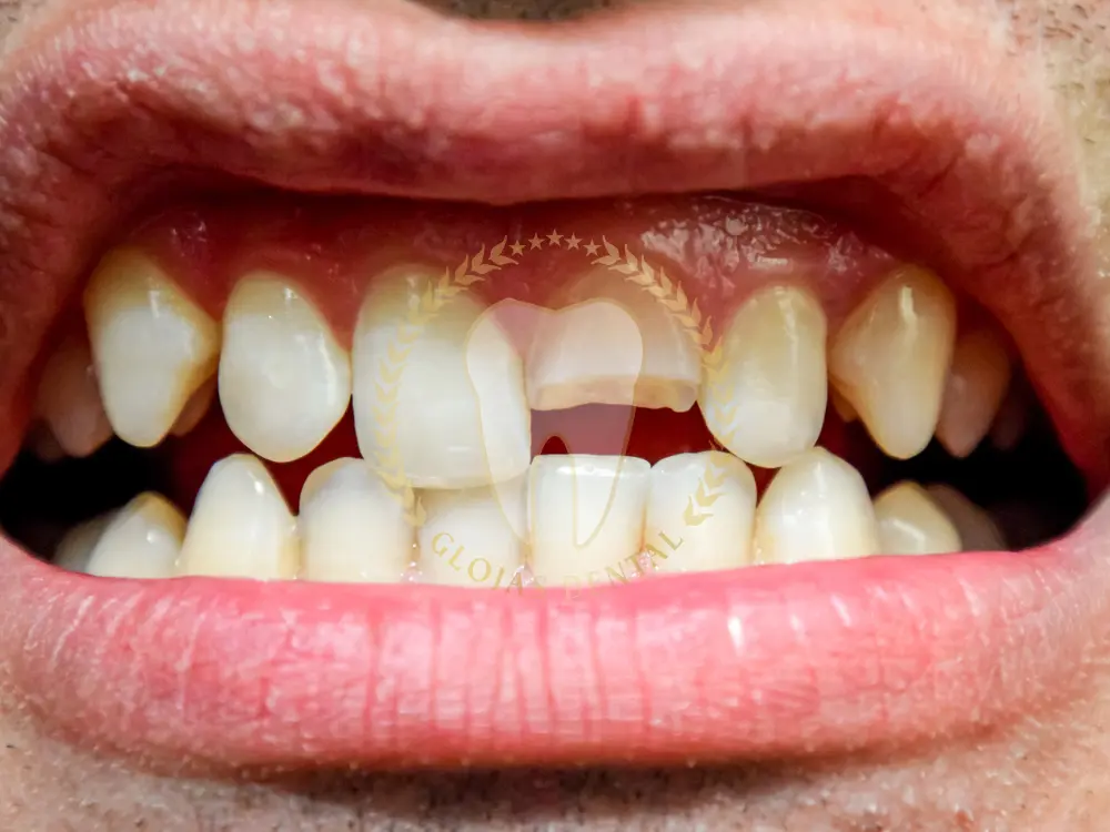 cracked-tooth-treatment