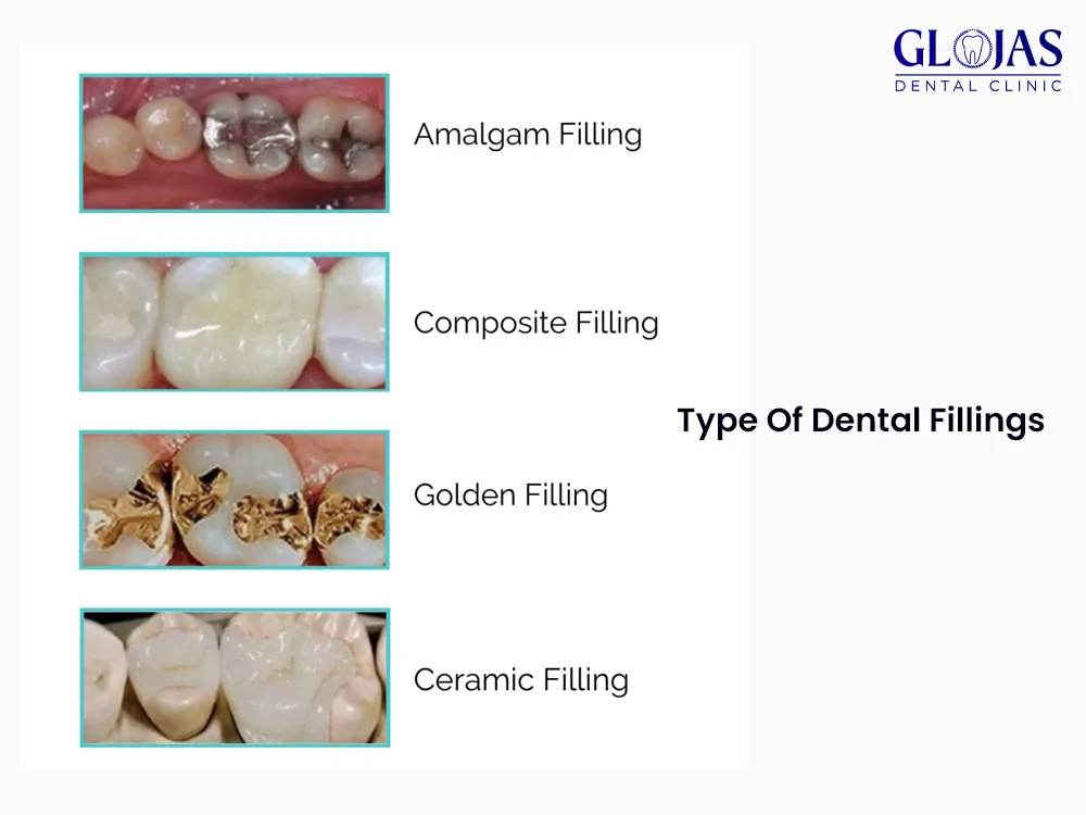 dental-fillings-dental-clinic-malaysia-klinik-pergigian-kuala-lumpur