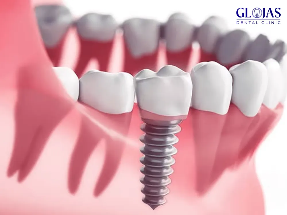 dental-implants-dental-clinic-malaysia-klinik-pergigian-kuala-lumpur