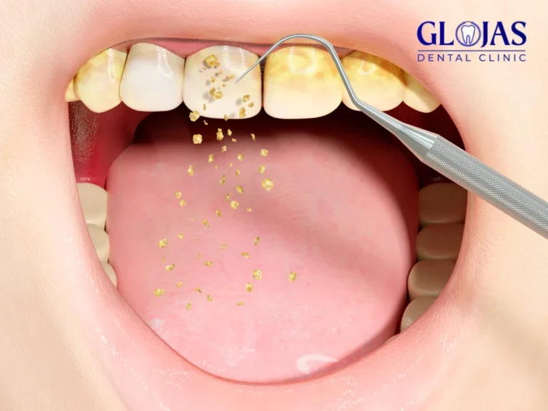 dental-tartar-removal