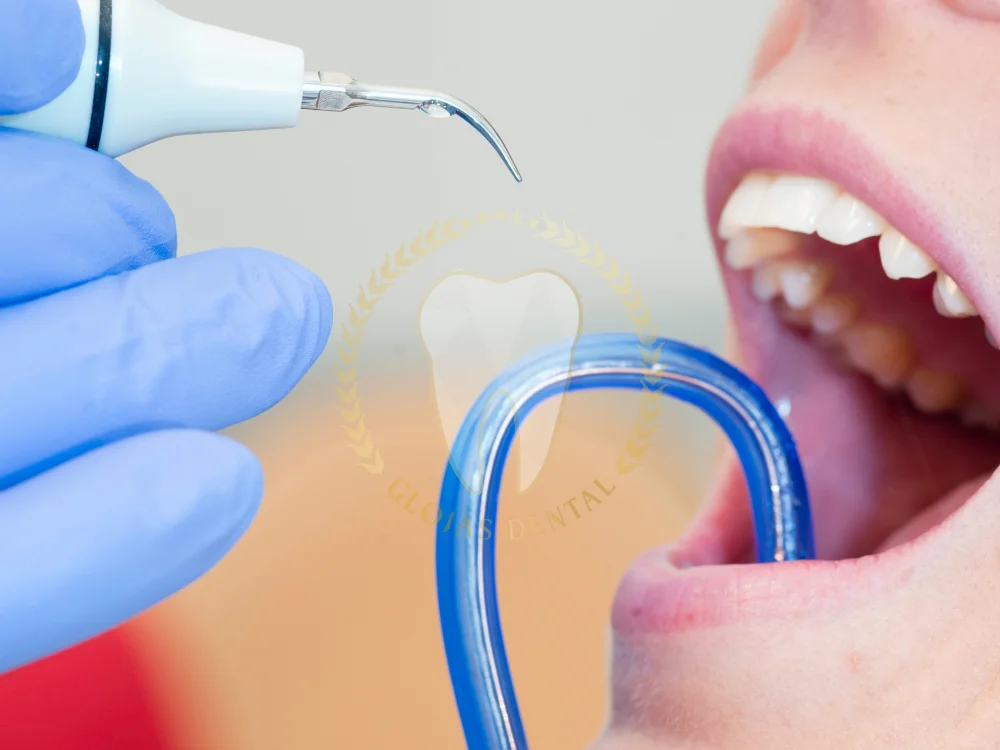 dental-tartar-removal
