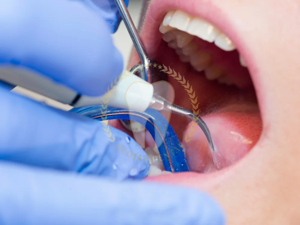 dental-tartar-removal