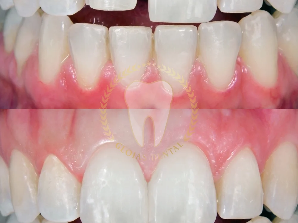 dental-veneers