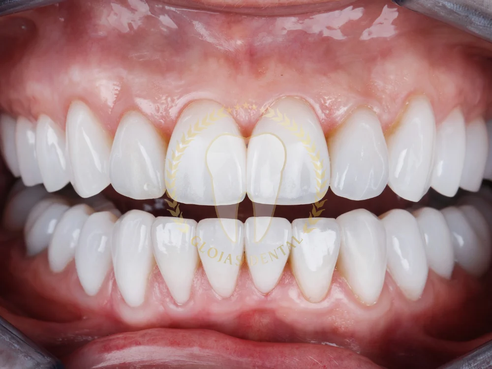 dental-veneers