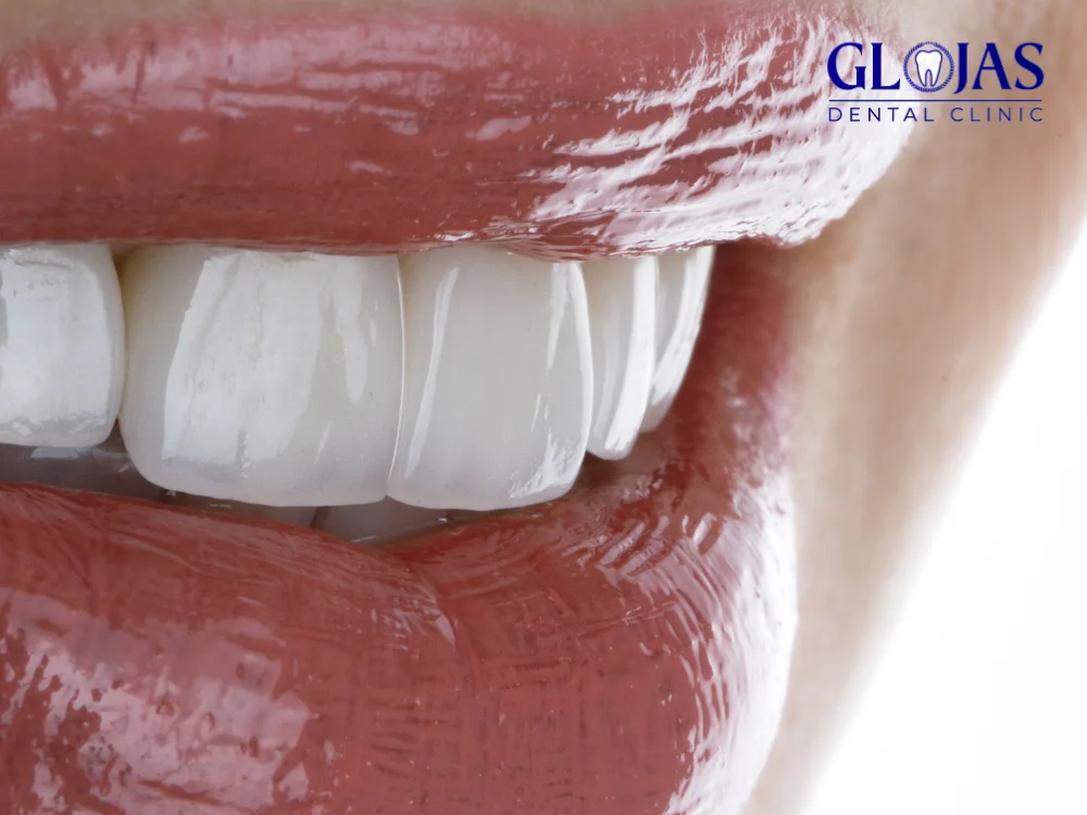 dental-veneers