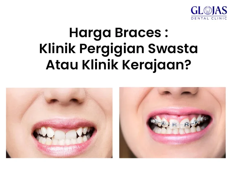 harga-braces-klinik-swasta-kerajaan