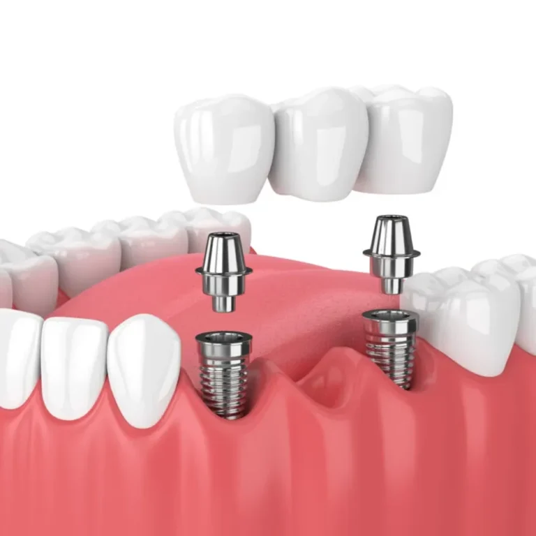 implant-dental-clinic-malaysia-glojas