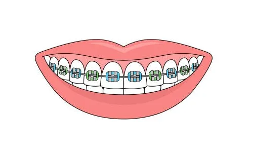 metal-braces-dental-clinic-malaysia-klinik-pergigian-kuala-lumpur