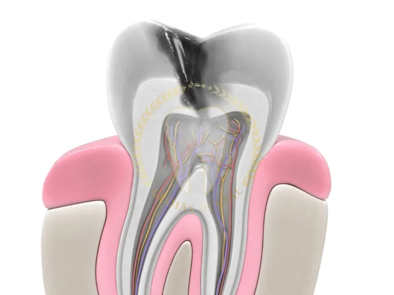 root-canal-step-by-step