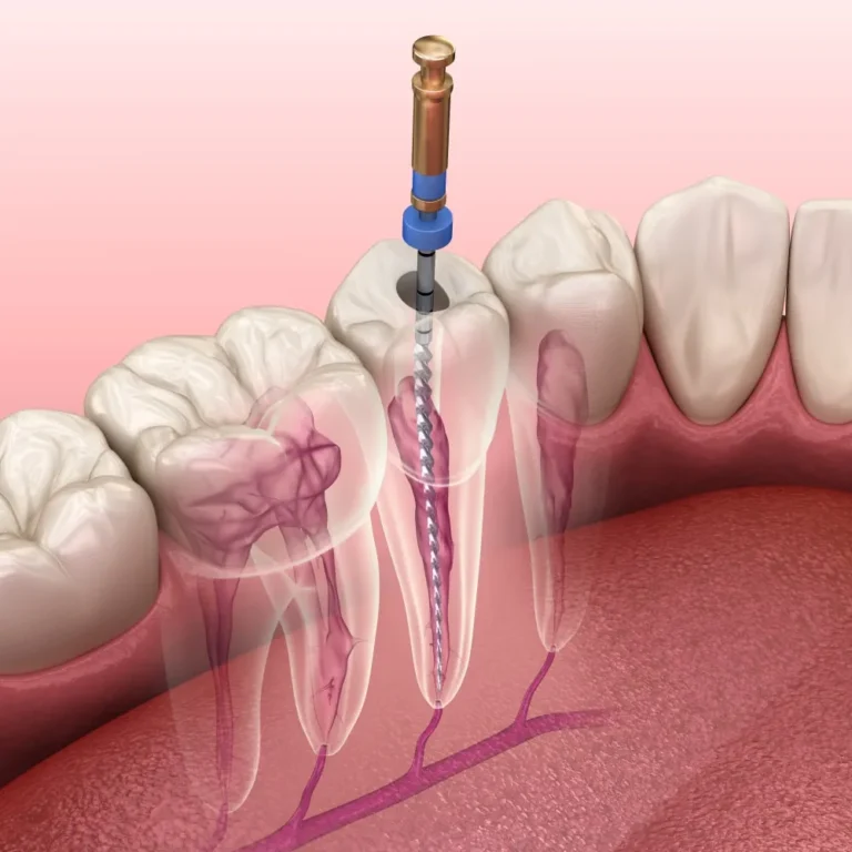 root-canal-treatment-dental-clinic-malaysia-klinik-pergigian-kuala-lumpur-dentist