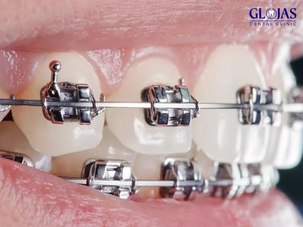 self-ligating-braces-orthodontics-dental-clinic-malaysia-klinik-pergigian-kuala-lumpur