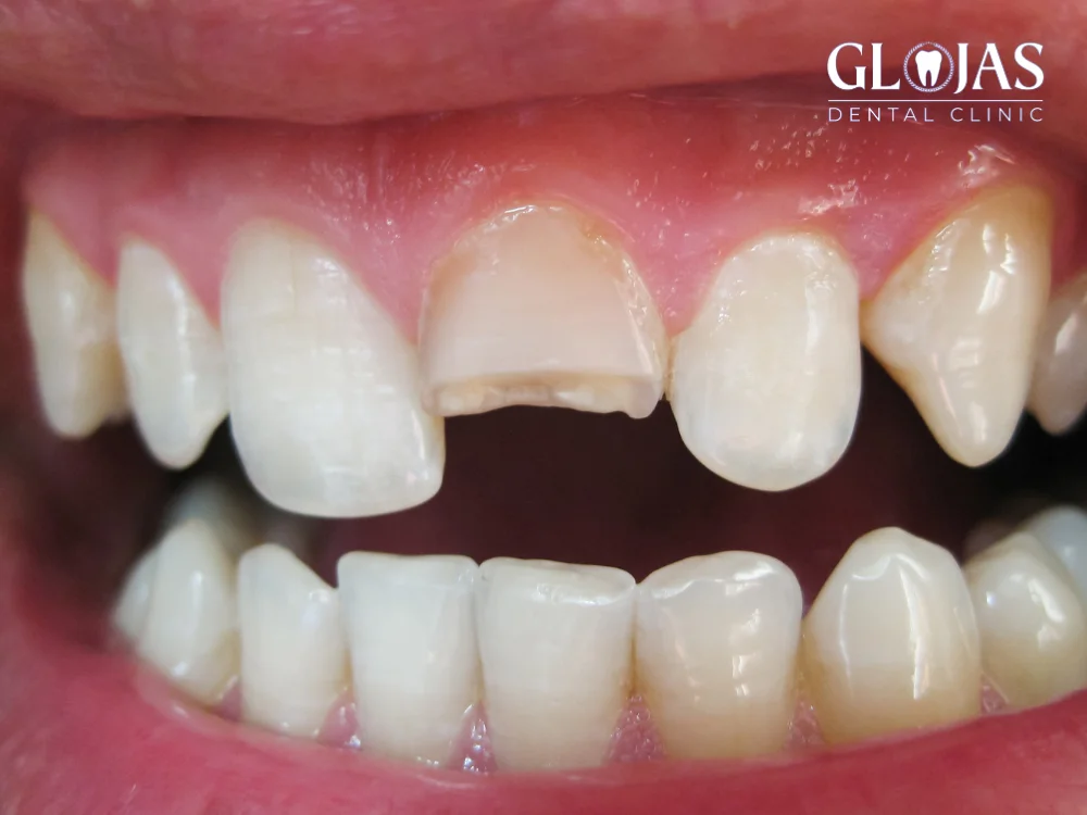5 Proven Solutions for Fixing Teeth When They Broke 27 teeth-broke