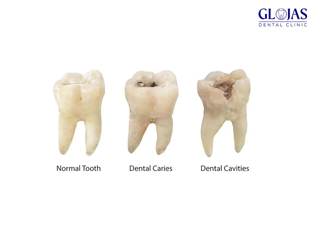 tooth-cavities-tips-dental-clinic-malaysia-klinik-pergigian-kuala-lumpur-dentist-1