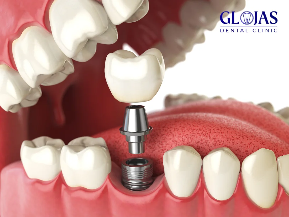 tooth-implant