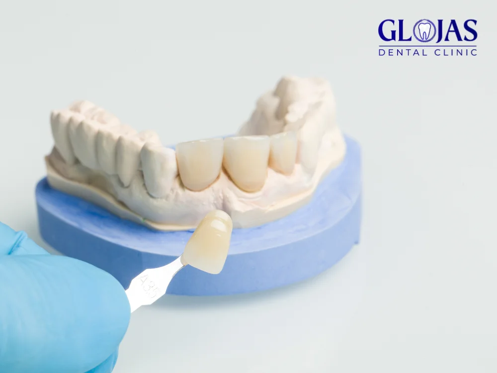 7 Incredible Reasons to Choose Veneers Near Me for a Perfect Smile 7 veneers-near-me