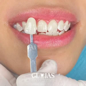 dental-clinic-malaysia-whitening-after