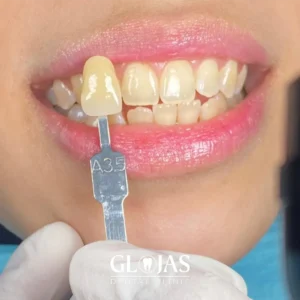 dental-clinic-malaysia-whitening-before