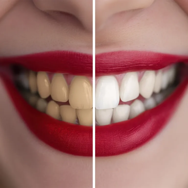 veneers-dental-clinic-malaysia-glojas