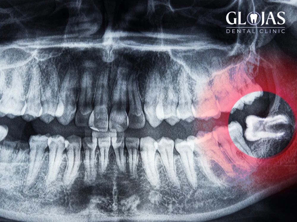 wisdom-teeth-removal