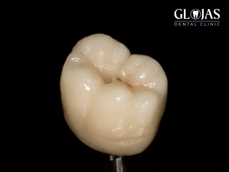 zirconia-crown
