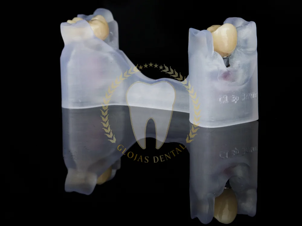 zirconia-crown