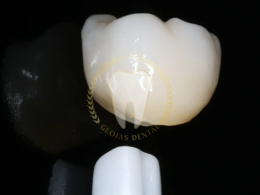 zirconia-crown