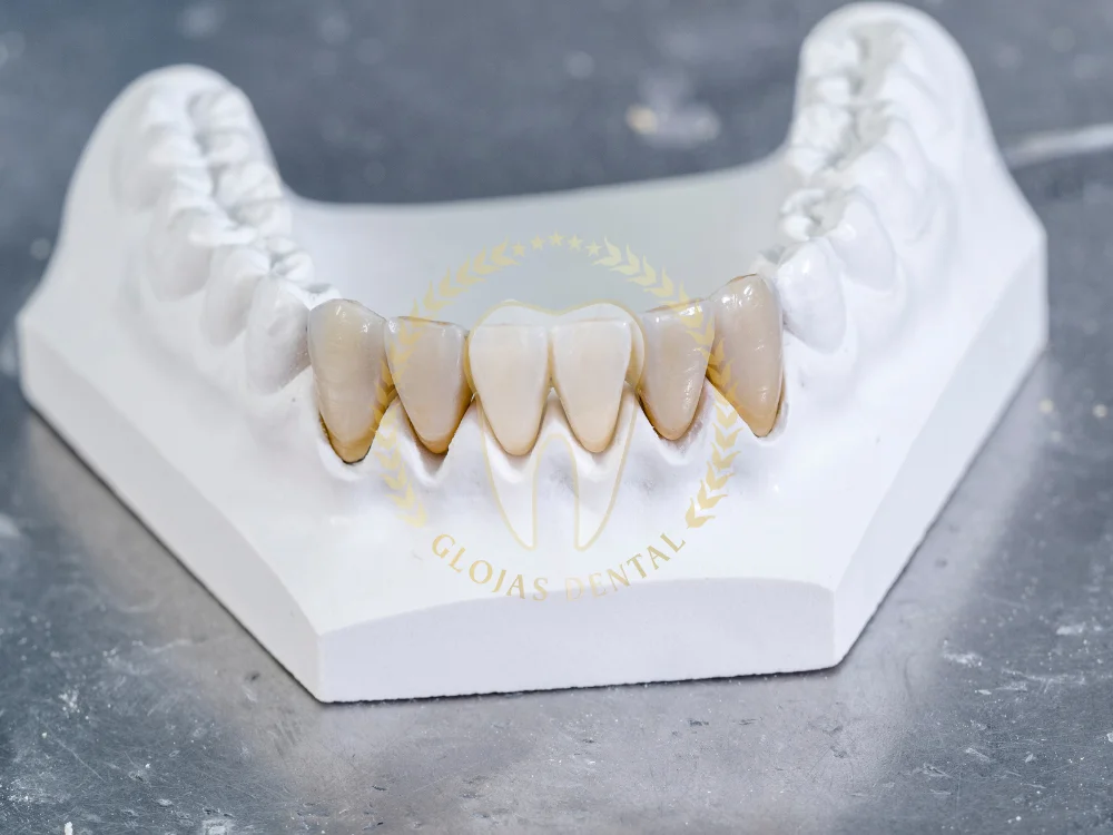 zirconia-crown