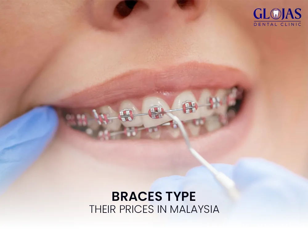 braces-types-prices-malaysia-1