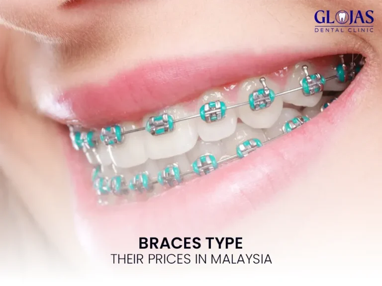 braces-types-prices-malaysia