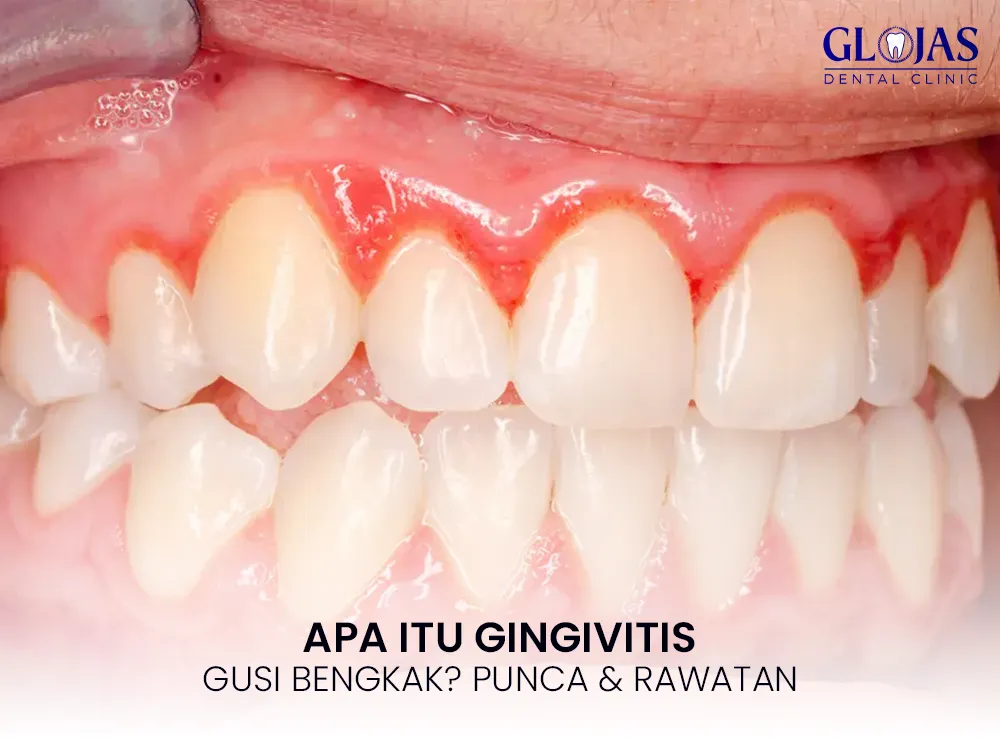 gingivitis-gusi-bengkak-cara-rawat