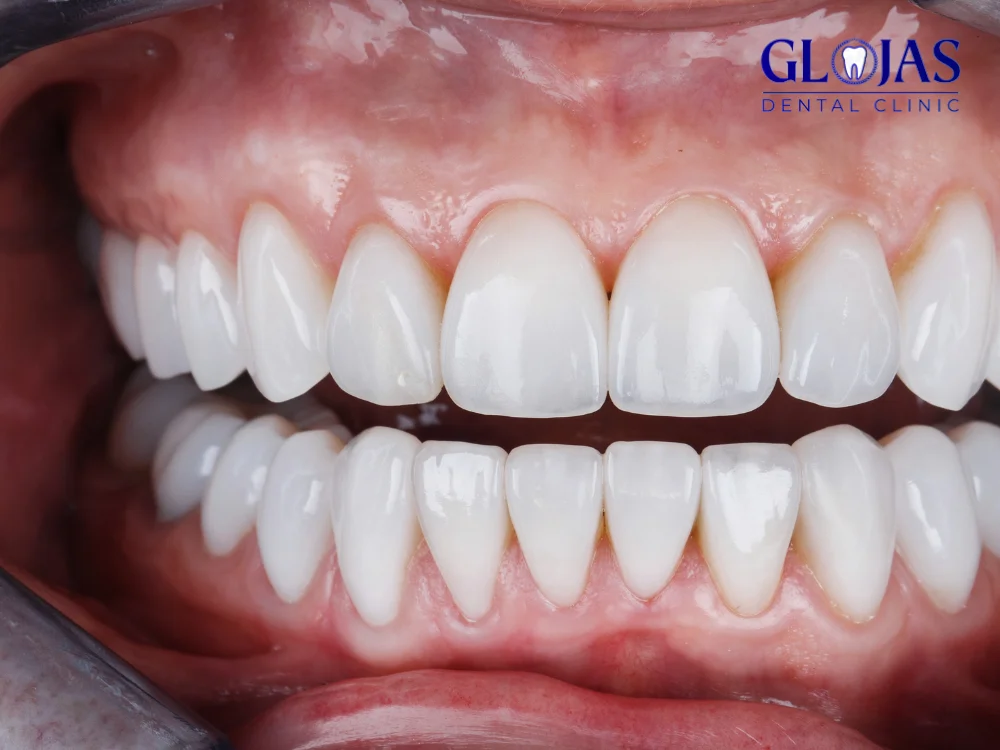 Teeth veneers cosmetic dentistry treatment