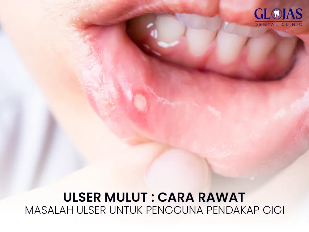 ulser-bibir-cara-rawat